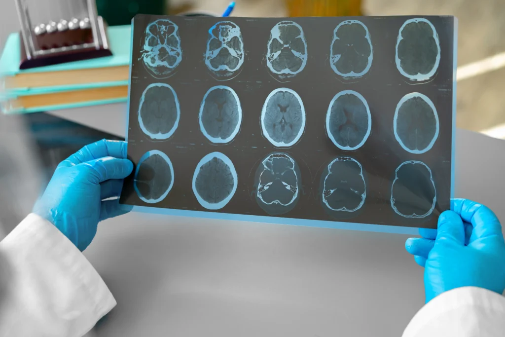 Meningit nədir? Meningit necə yaranır? (Həkimə sual)